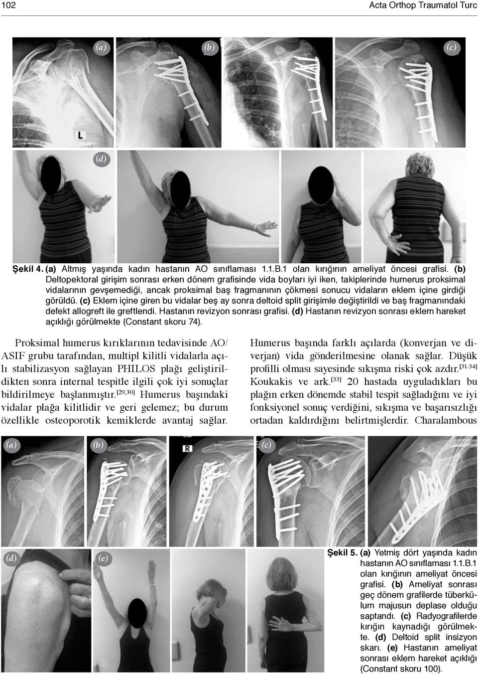 içine girdiği görüldü. Eklem içine giren bu vidalar beş ay sonra deltoid split girişimle değiştirildi ve baş fragmanındaki defekt allogreft ile greftlendi. Hastanın revizyon sonrası grafisi.