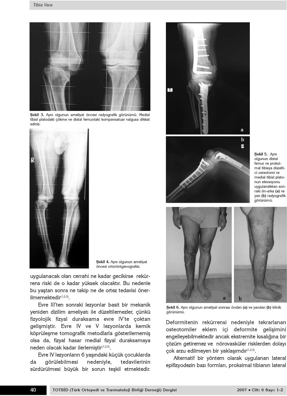 Ayný olgunun ameliyat öncesi ortoröntgenografisi. uygulanacak olan cerrahi ne kadar gecikirse rekürrens riski de o kadar yüksek olacaktýr.