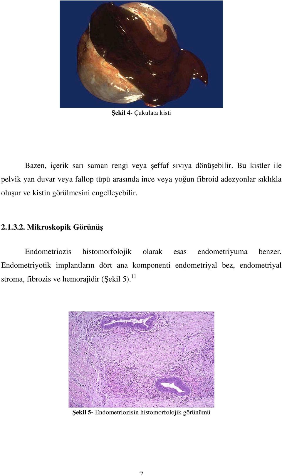 görülmesini engelleyebilir. 2.1.3.2. Mikroskopik Görünüş Endometriozis histomorfolojik olarak esas endometriyuma benzer.