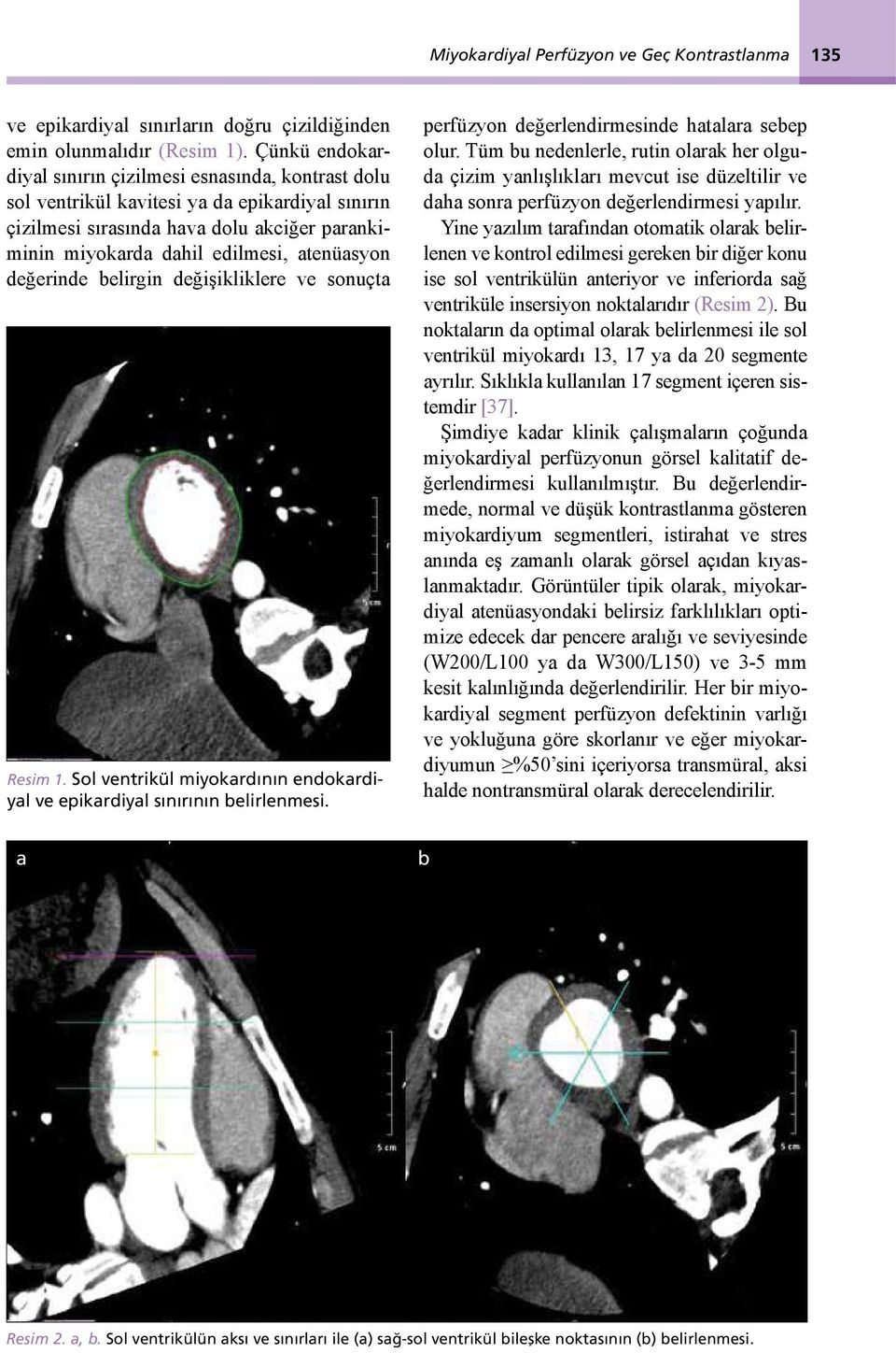 değerinde belirgin değişikliklere ve sonuçta Resim 1. Sol ventrikül miyokardının endokardiyal ve epikardiyal sınırının belirlenmesi. perfüzyon değerlendirmesinde hatalara sebep olur.