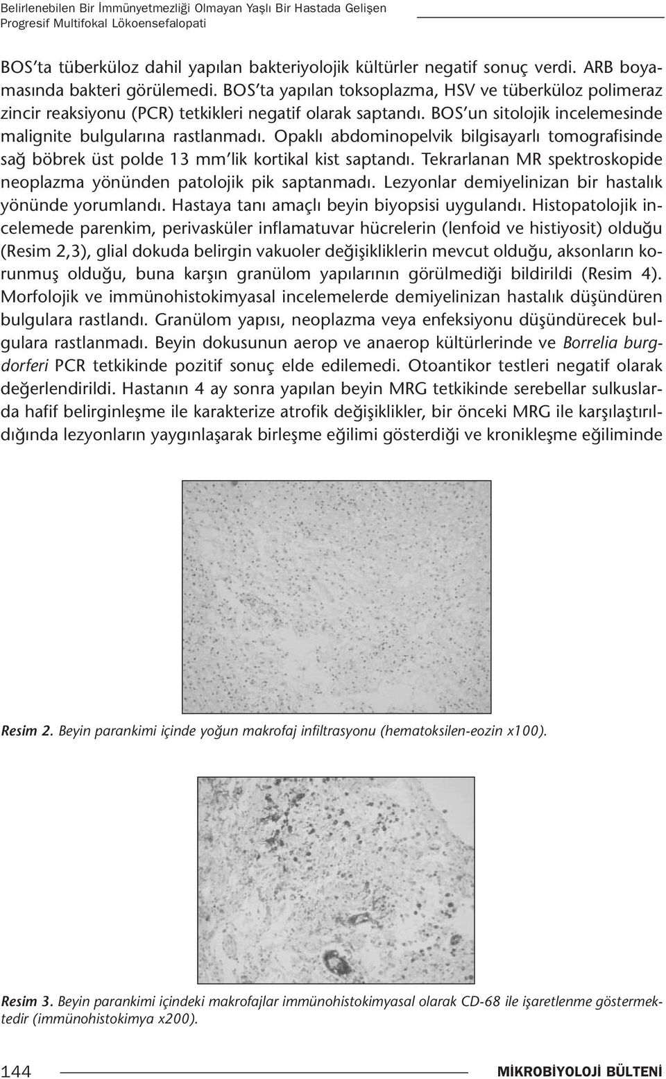 BOS un sitolojik incelemesinde malignite bulgularına rastlanmadı. Opaklı abdominopelvik bilgisayarlı tomografisinde sağ böbrek üst polde 13 mm lik kortikal kist saptandı.