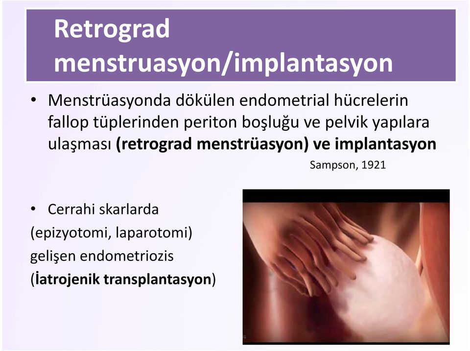 (retrograd menstrüasyon) ve implantasyon Sampson, 1921 Cerrahi skarlarda