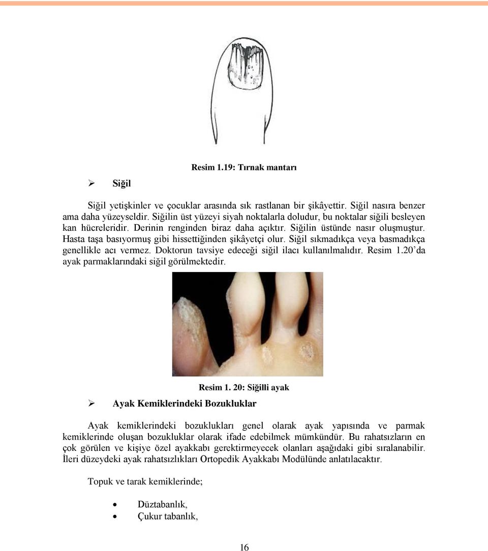 Hasta taşa basıyormuş gibi hissettiğinden şikâyetçi olur. Siğil sıkmadıkça veya basmadıkça genellikle acı vermez. Doktorun tavsiye edeceği siğil ilacı kullanılmalıdır. Resim 1.