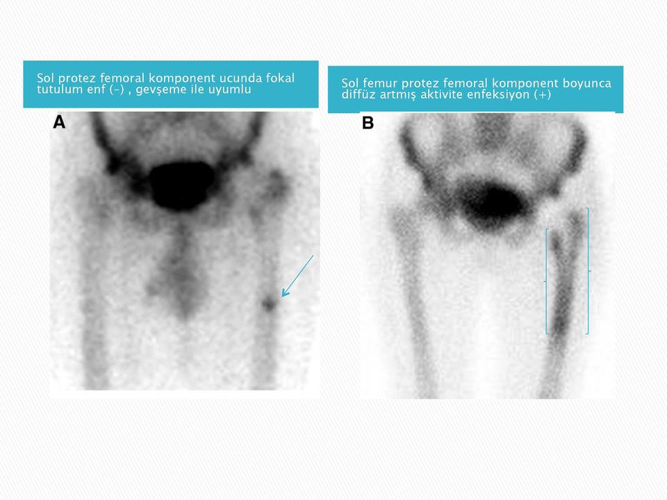 uyumlu Sol femur protez femoral