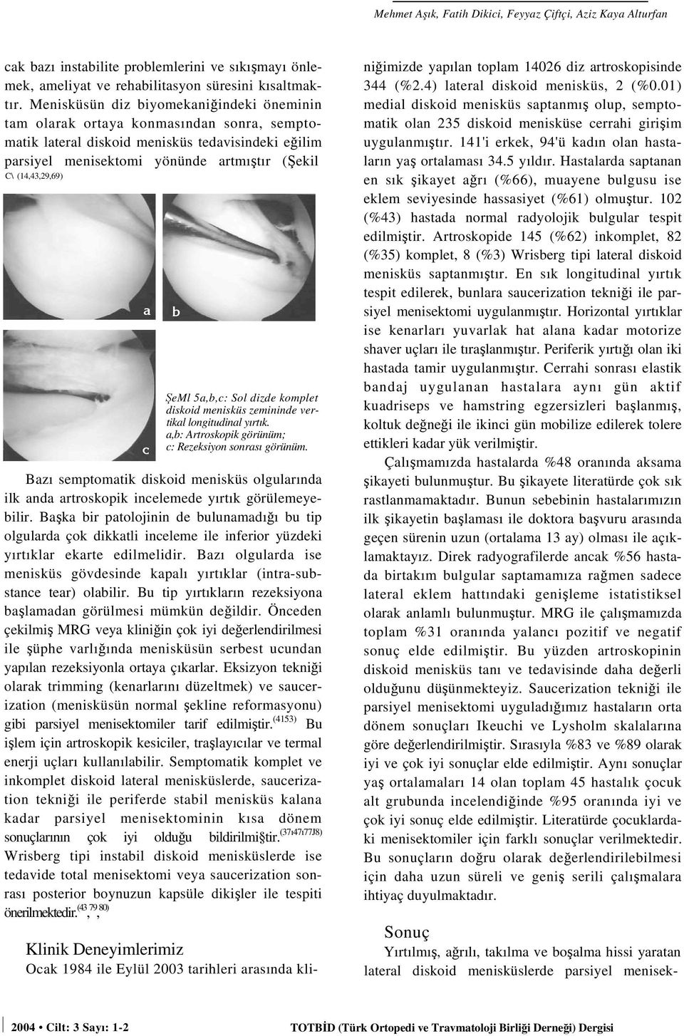 ŞeMl 5a,b,c: Sol dizde komplet diskoid menisküs zemininde vertikal longitudinal yırtık. a,b: Artroskopik görünüm; c: Rezeksiyon sonrası görünüm.