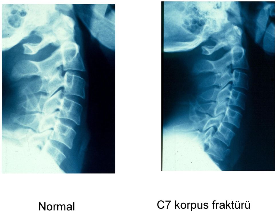 fraktürü