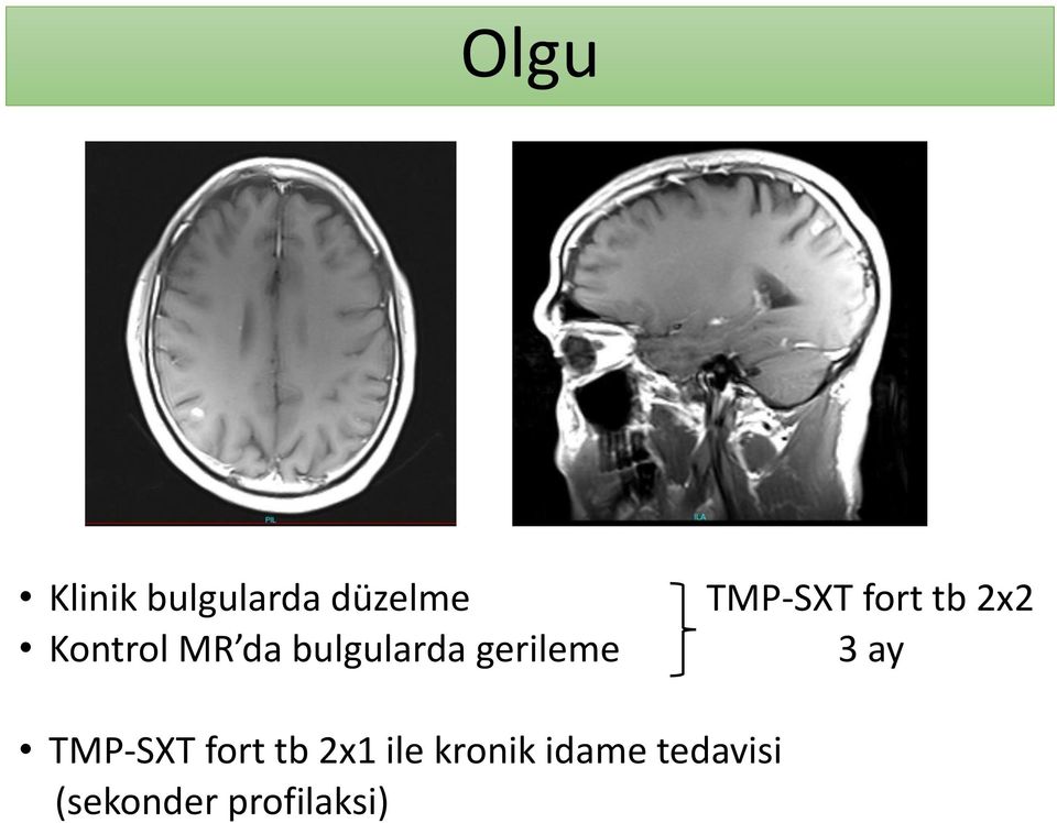 tb 2x2 3 ay TMP-SXT fort tb 2x1 ile