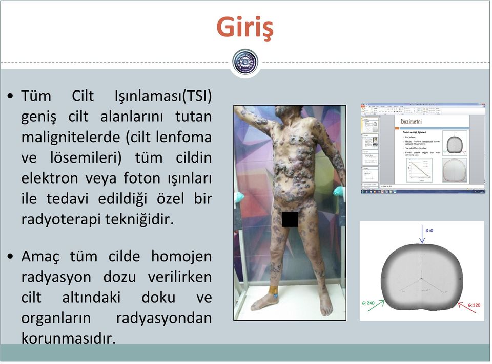 tedavi edildiği özel bir radyoterapi tekniğidir.