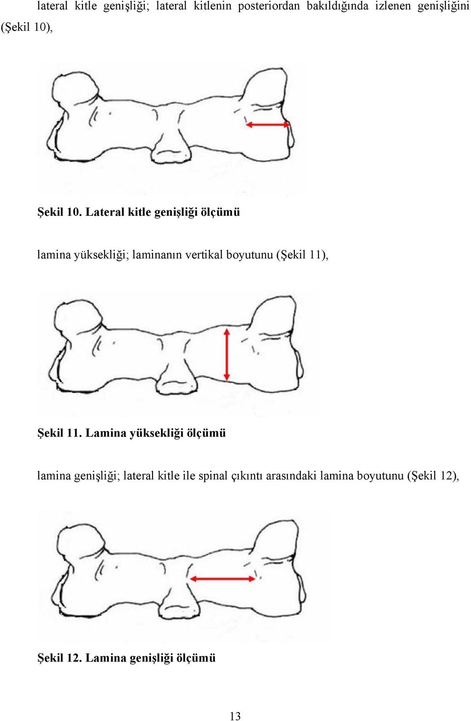 Lateral kitle genişliği ölçümü lamina yüksekliği; laminanın vertikal boyutunu (Şekil 11),