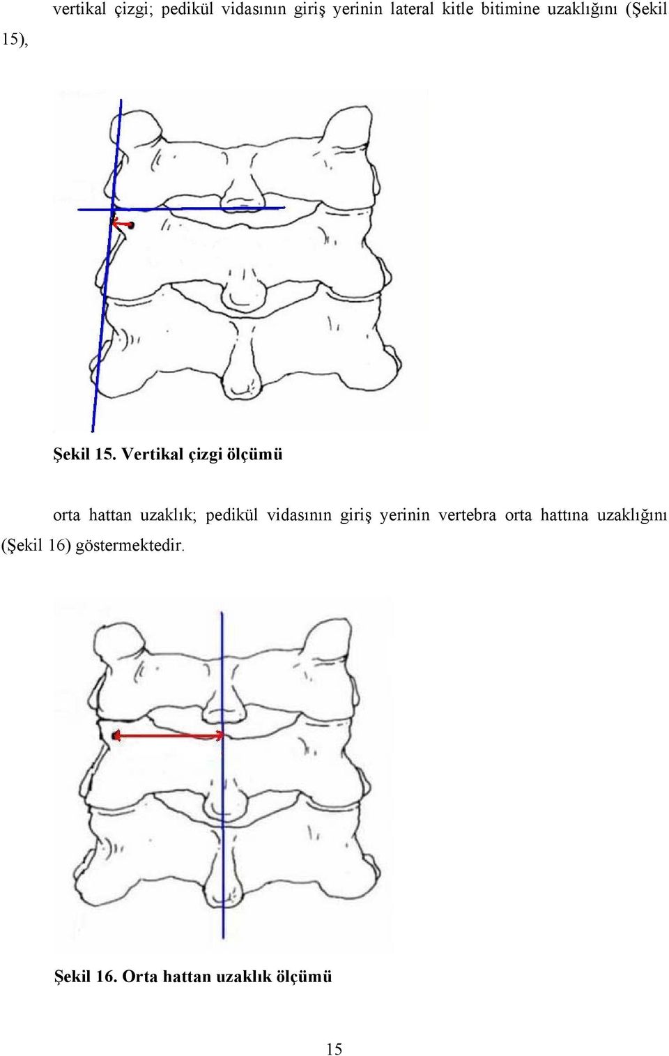 Vertikal çizgi ölçümü orta hattan uzaklık; pedikül vidasının giriş