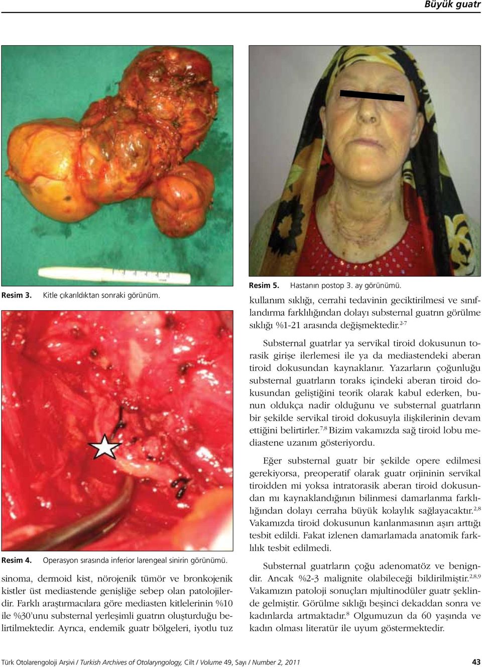 Farklı araştırmacılara göre mediasten kitlelerinin %10 ile %30 unu substernal yerleşimli guatrın oluşturduğu belirtilmektedir. Ayrıca, endemik guatr bölgeleri, iyotlu tuz Resim 5. Hastanın postop 3.