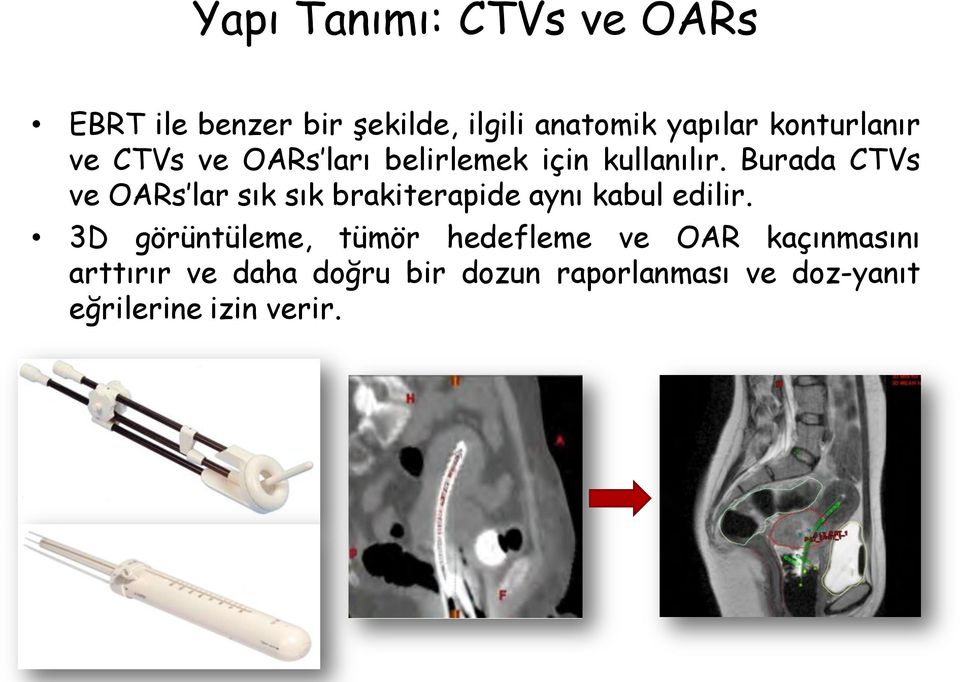 Burada CTVs ve OARs lar sık sık brakiterapide aynı kabul edilir.