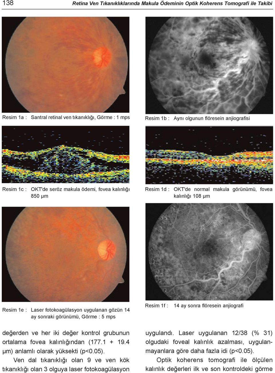 mps Resim 1f : 14 ay sonra flöresein anjiografi deðerden ve her iki deðer kontrol grubunun ortalama fovea kalýnlýðýndan (177.1 + 19.4 µm) anlamlý olarak yüksekti (p<0.05).