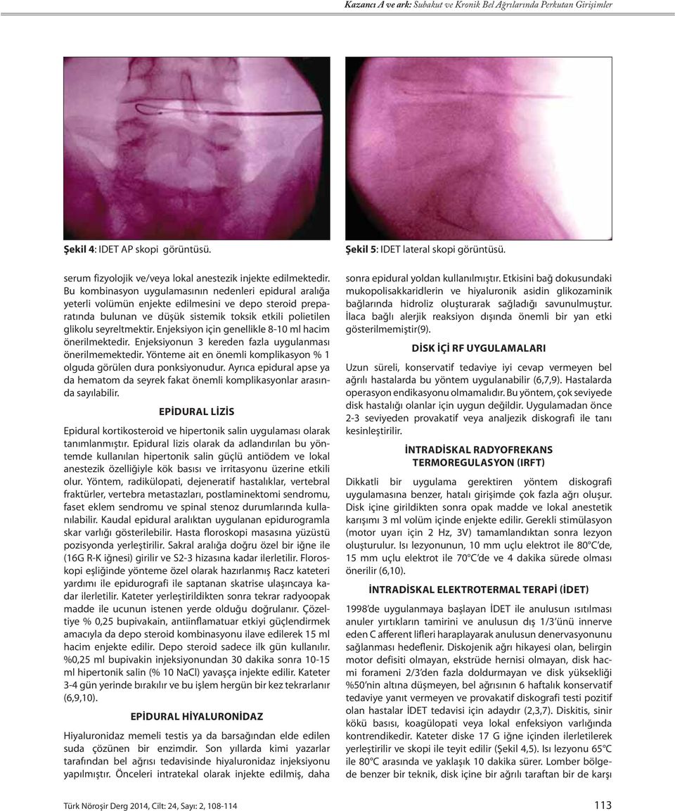 Enjeksiyon için genellikle 8-10 ml hacim önerilmektedir. Enjeksiyonun 3 kereden fazla uygulanması önerilmemektedir. Yönteme ait en önemli komplikasyon % 1 olguda görülen dura ponksiyonudur.