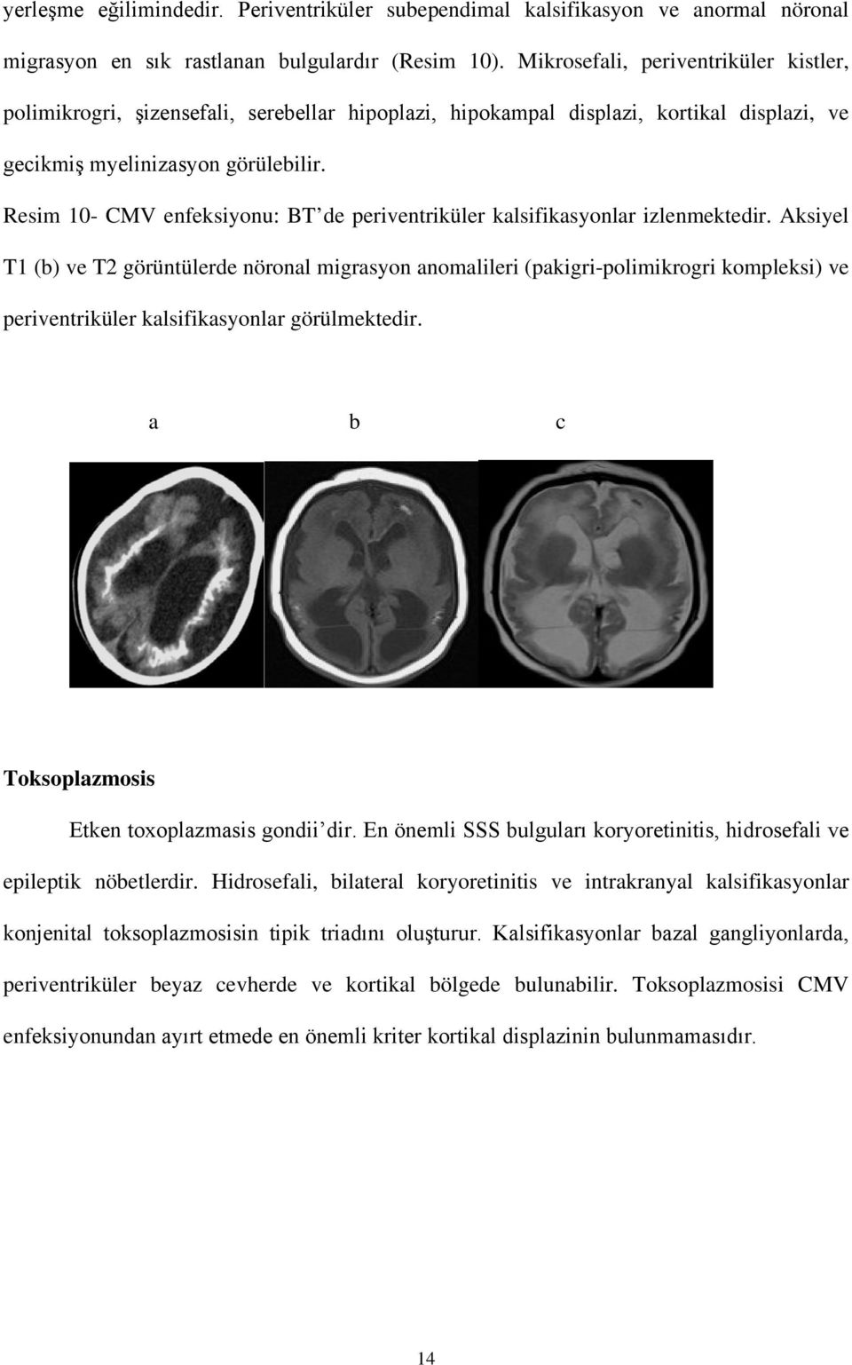 Resim 10- CMV enfeksiyonu: BT de periventriküler kalsifikasyonlar izlenmektedir.