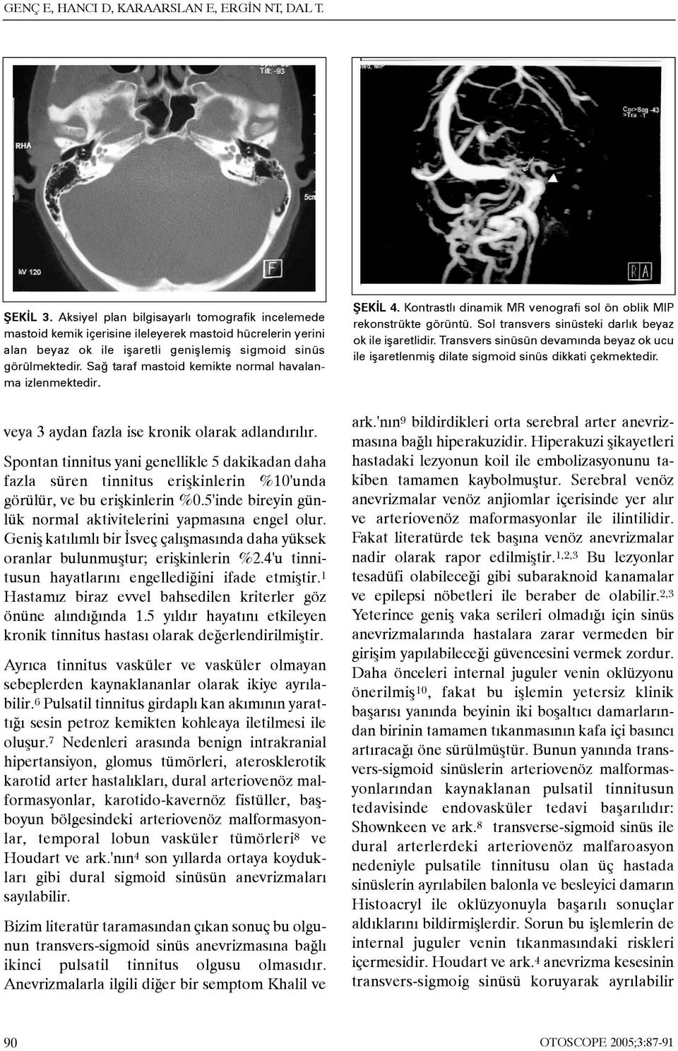 Sað taraf mastoid kemikte normal havalanma izlenmektedir. ÞEKÝL 4. Kontrastlý dinamik MR venografi sol ön oblik MIP rekonstrükte görüntü. Sol transvers sinüsteki darlýk beyaz ok ile iþaretlidir.