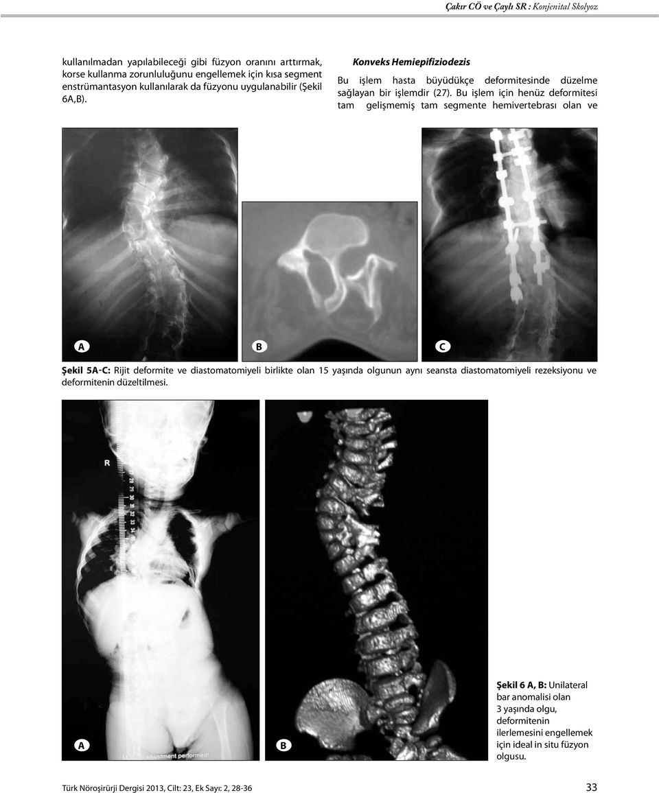 Bu işlem için henüz deformitesi tam gelişmemiş tam segmente hemivertebrası olan ve A b c Şekil 5a-c: Rijit deformite ve diastomatomiyeli birlikte olan 15 yaşında