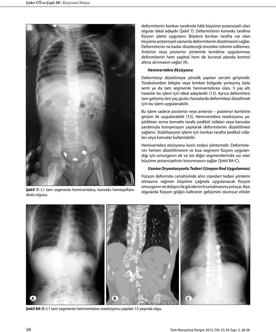 Deformitenin ne kadar düzeleceği önceden tahmin edilemez. Anterior veya posterior yöntemle kombine uygulanması deformitenin hem sagittal hem de koronal planda kontrol altına alınmasını sağlar (9).