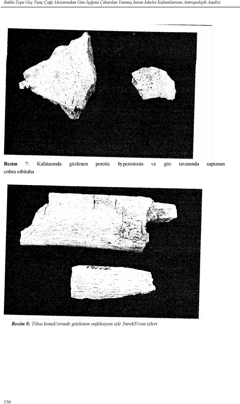 gözlenen porotic hyperostosis ve göz tavanında saptanan crıbra