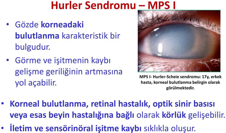 MPS I- Hurler-Scheie sendromu: 17y, erkek hasta, korneal bulutlanma belirgin olarak görülmektedir.