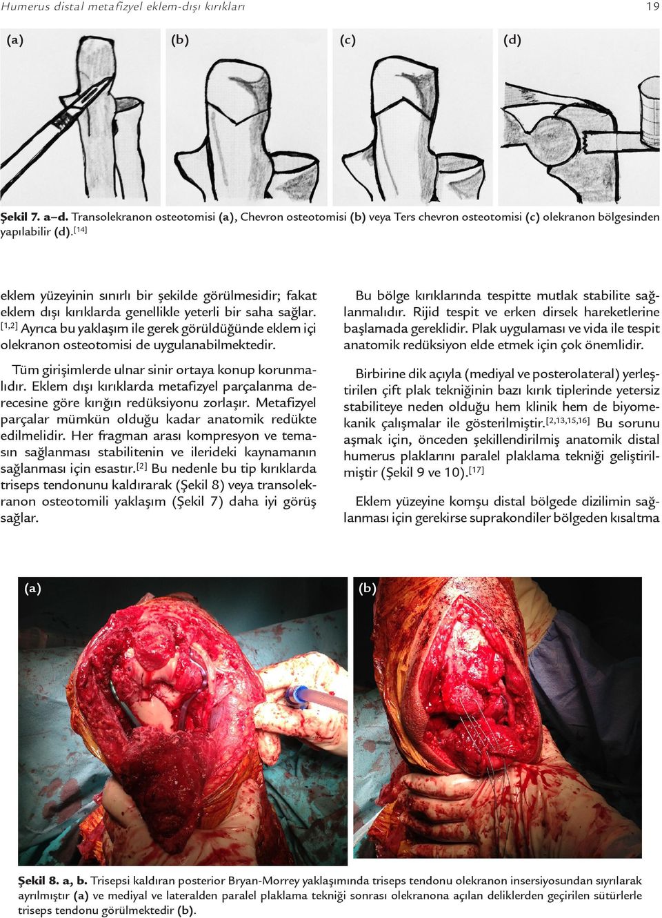 [1,2] Ayrıca bu yaklaşım ile gerek görüldüğünde eklem içi olekranon osteotomisi de uygulanabilmektedir. Bu bölge kırıklarında tespitte mutlak stabilite sağlanmalıdır.