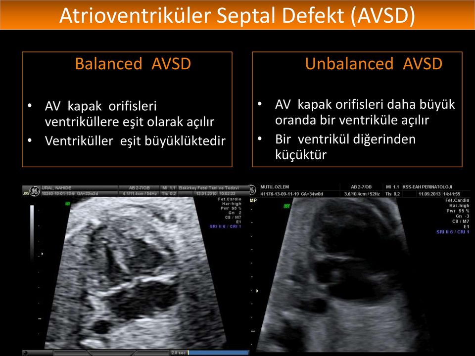 büyüklüktedir Unbalanced AVSD AV kapak orifisleri daha büyük