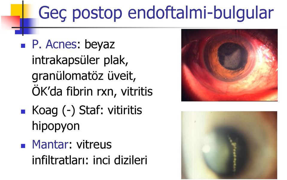 üveit, ÖK da fibrin rxn, vitritis Koag (-)