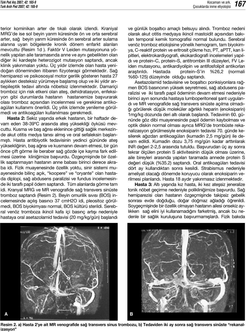 Faktör V Leiden mutasyonuna yönelik yap lan aile taramas nda anne ve ayn gebelikten olan di er iki kardeflte heterozigot mutasyon saptand, ancak klinik yak nmalar yoktu.