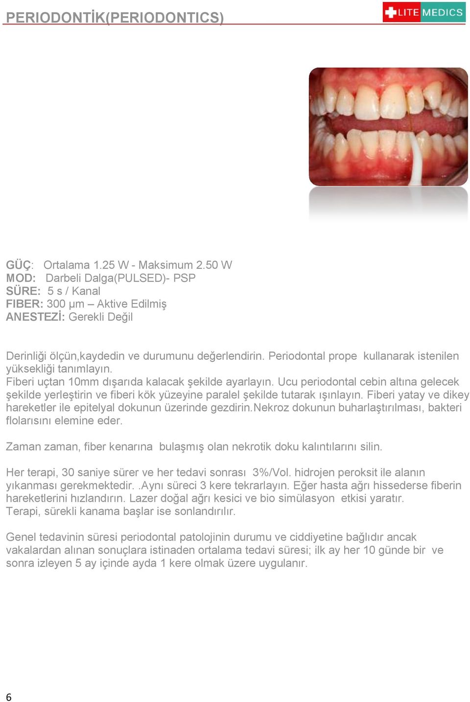 Periodontal prope kullanarak istenilen yüksekliği tanımlayın. Fiberi uçtan 10mm dışarıda kalacak şekilde ayarlayın.