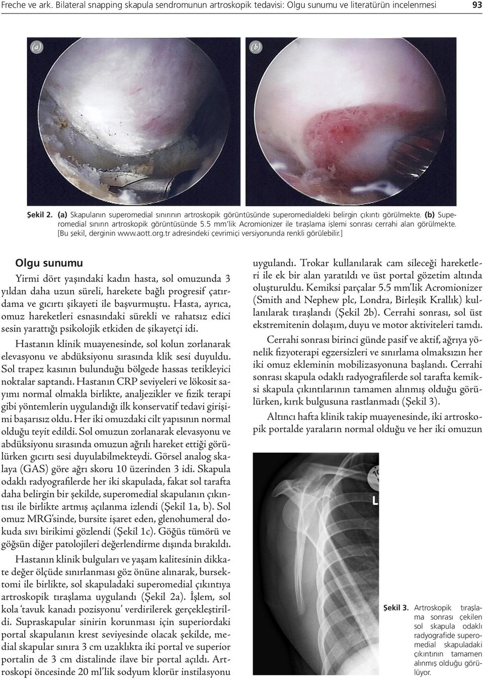 5 mm lik Acromionizer ile tıraşlama işlemi sonrası cerrahi alan görülmekte. [Bu şekil, derginin www.aott.org.tr adresindeki çevrimiçi versiyonunda renkli görülebilir.