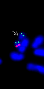 Microdeletion konfirmasyonu (1 kırımızı sinyalin kaybı) Deleted chromosome red signal absent Red signal TUPLE1 (HIRA) locus Green signal