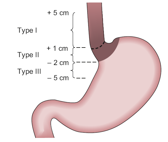 ÖGB Tümörleri - Siewert Sınıflaması Tip1: Distal özofagus adenokanseri, tümörün GÖB nin 1-5 cm üzerinde Tip 2: Gerçek kardia adenokanseri, Tm GÖB nin 1 cm üzeri ile 2cm altında