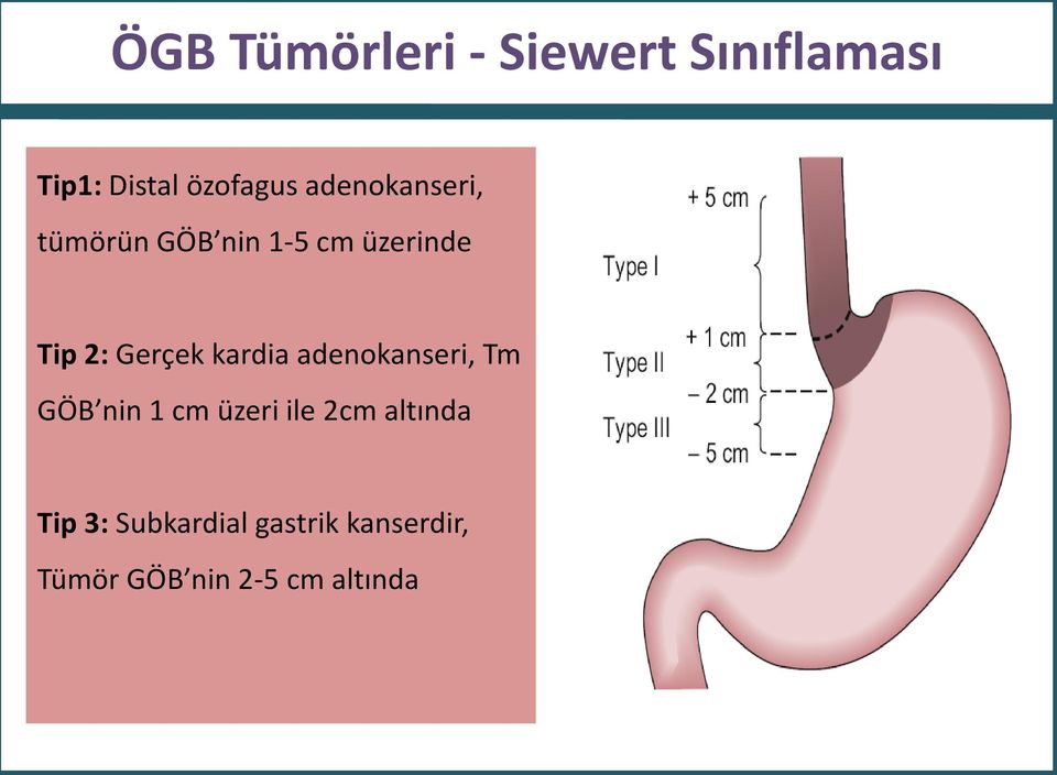 Tip 3: Subkardial gastrik kanserdir, Tümör GÖB nin 2-5 cm altında *J Surg Oncol