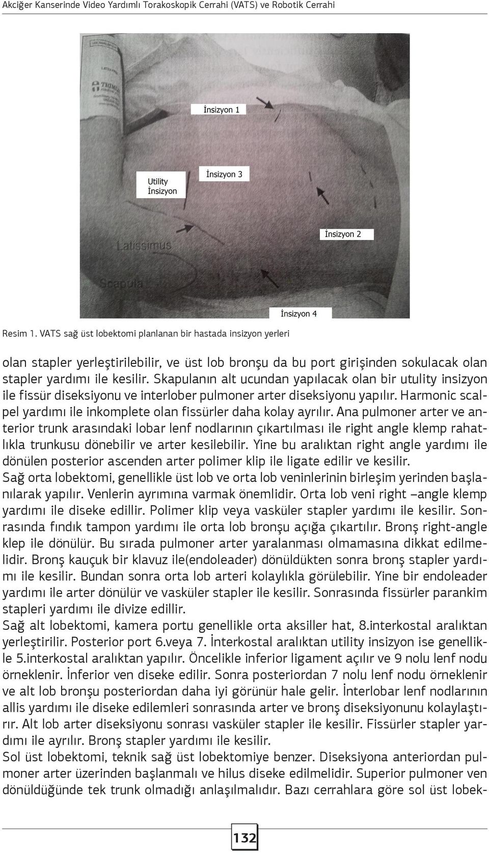 Harmonic scalpel yardımı ile inkomplete olan fissürler daha kolay ayrılır.