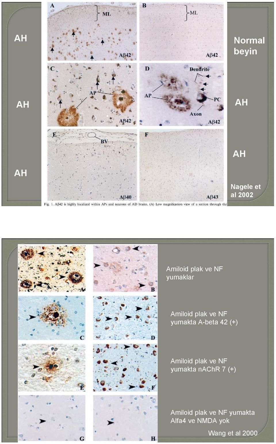 42 (+) Amiloid plak ve NF yumakta nachr 7 (+) Amiloid