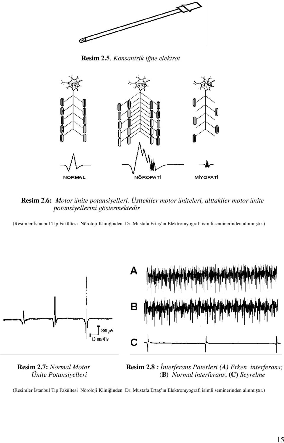 Dr. Mustafa Ertaş ın Elektromyografi isimli seminerinden alınmıştır.) Resim 2.7: Normal Motor Ünite Potansiyelleri Resim 2.