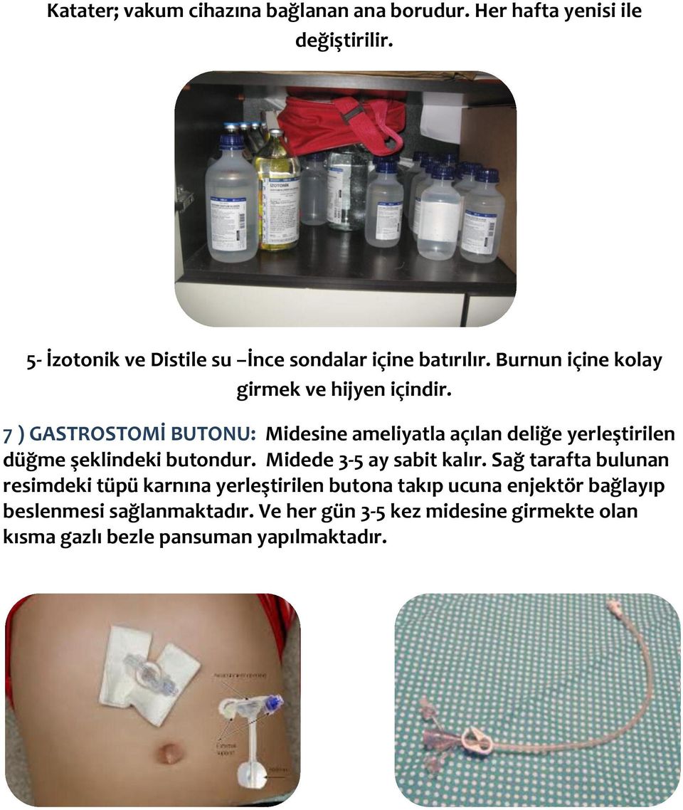 7 ) GASTROSTOMİ BUTONU: Midesine ameliyatla açılan deliğe yerleştirilen düğme şeklindeki butondur. Midede 3-5 ay sabit kalır.