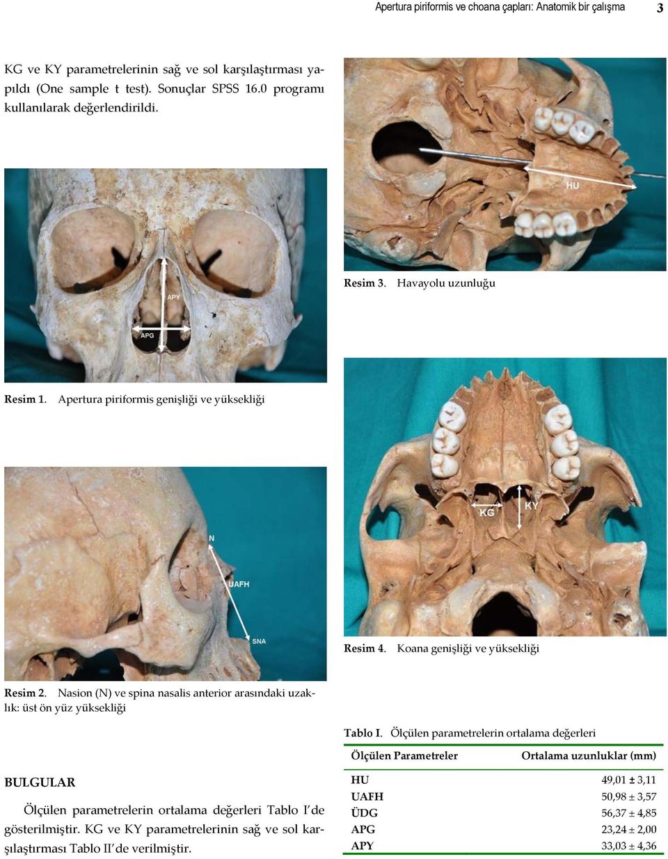 Nasion (N) ve spina nasalis anterior arasındaki uzaklık: üst ön yüz yüksekliği Tablo I.