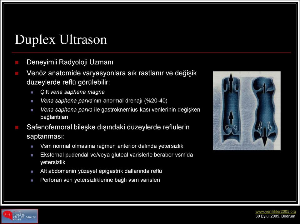 Safenofemoral bileşke dışındaki düzeylerde reflülerin saptanması: Vsm normal olmasına rağmen anterior dalında yetersizlik Eksternal pudendal