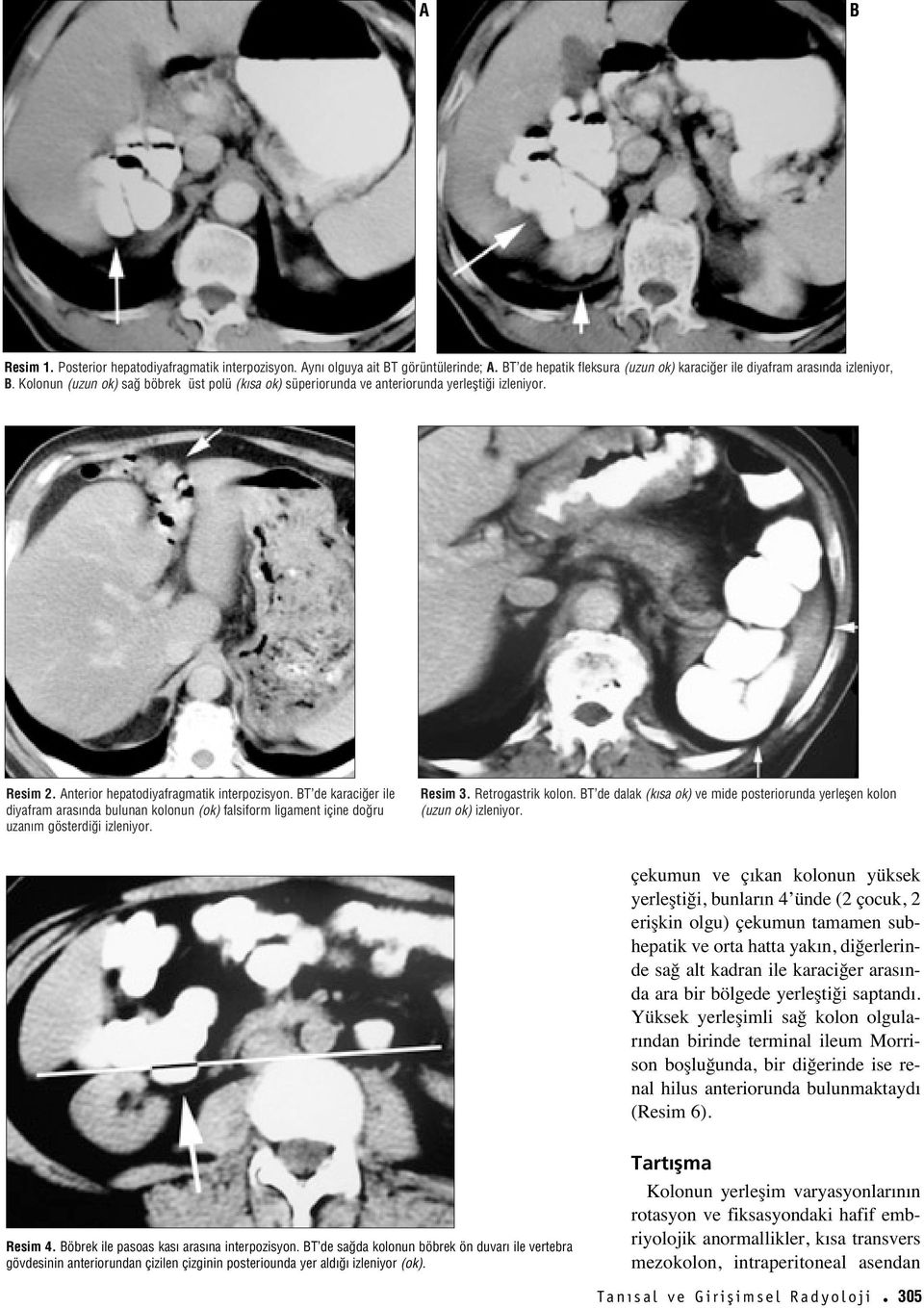 BT de karaci er ile diyafram aras nda bulunan kolonun (ok) falsiform ligament içine do ru uzan m gösterdi i izleniyor. Resim 3. Retrogastrik kolon.