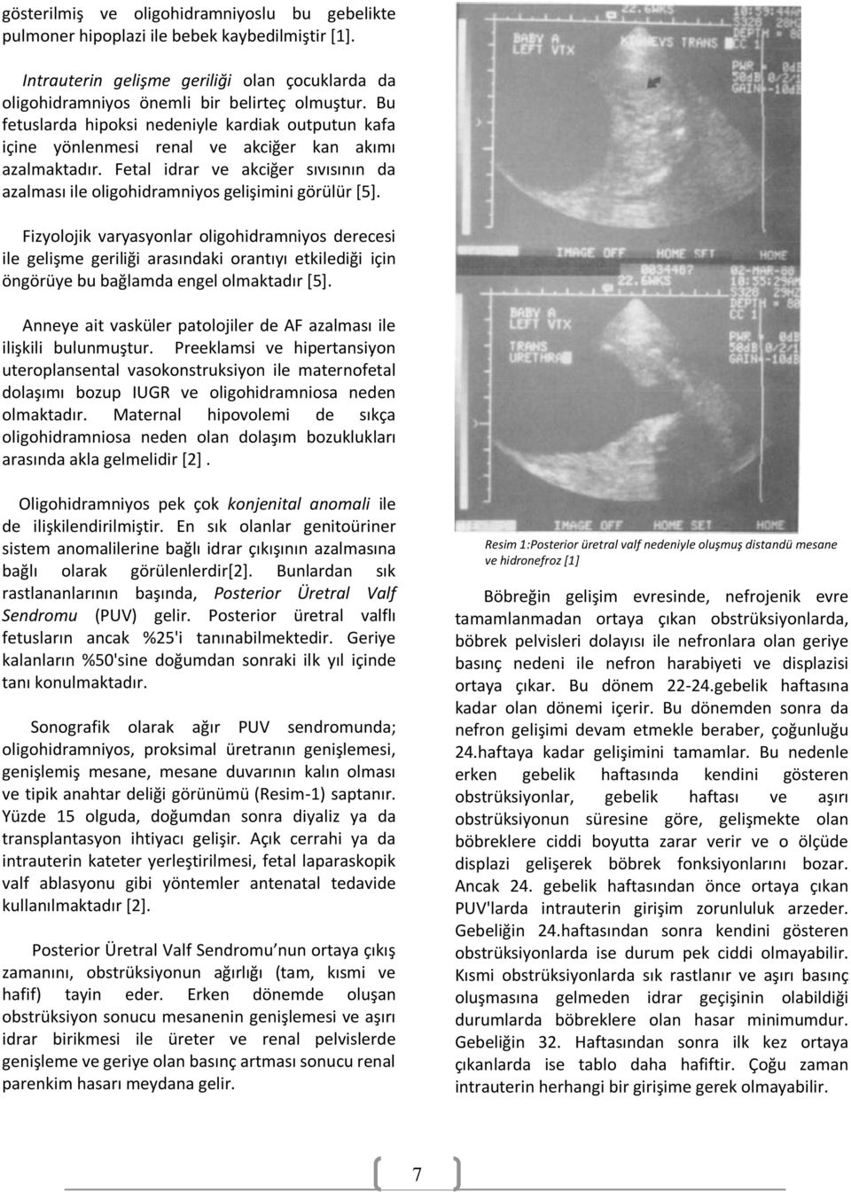 Fetal idrar ve akciğer sıvısının da azalması ile oligohidramniyos gelişimini görülür *5+.