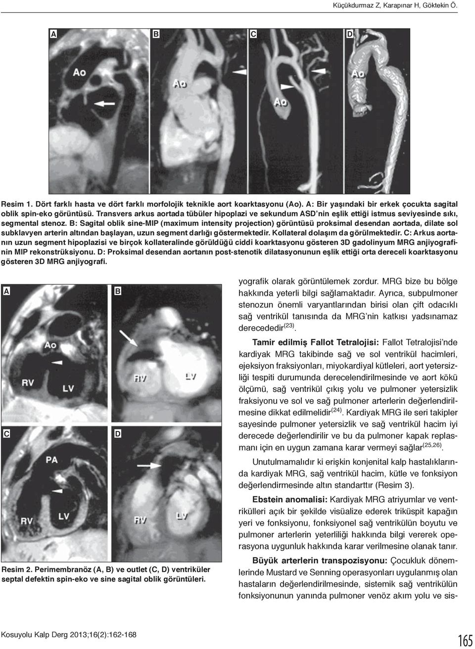 B: Sagital oblik sine-mip (maximum intensity projection) görüntüsü proksimal desendan aortada, dilate sol subklavyen arterin altından başlayan, uzun segment darlığı göstermektedir.