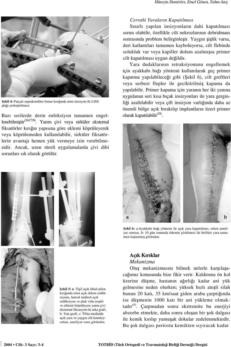 Yarım çivi veya sirküler eksternal fiksatörler kırığın yapısına göre eklemi köprüleyerek veya köprülemeden kullanılabilir, sirküler fiksatörlerin avantajı hemen yük vermeye izin verebilmesidir.