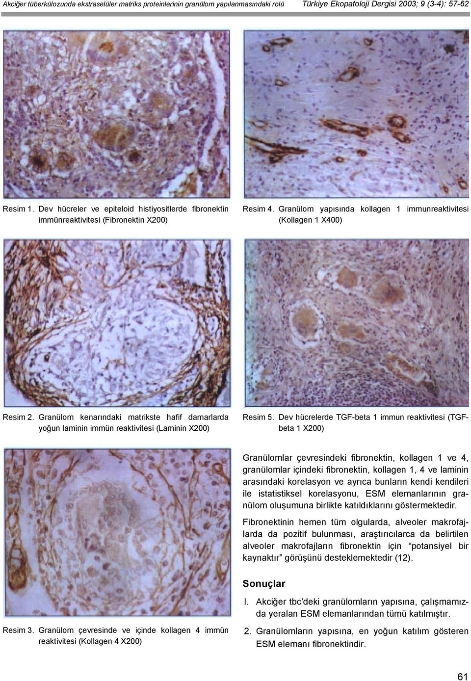 Granülom kenarındaki matrikste hafif damarlarda yoğun laminin immün reaktivitesi (Laminin X200) Resim 5.