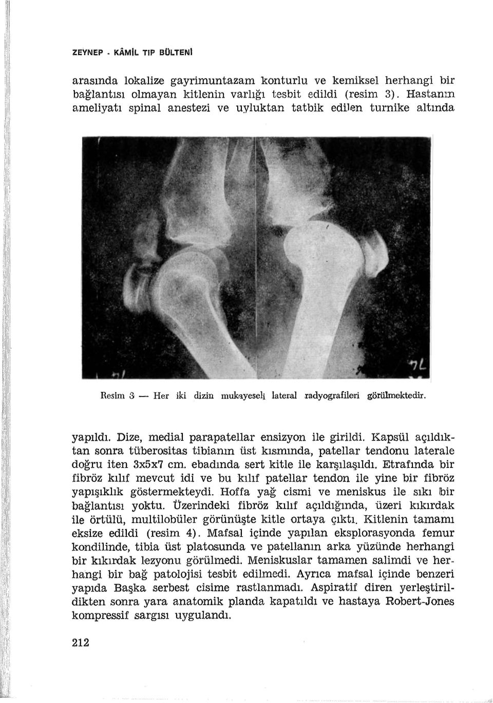 Dize, medial parapatellar ensizyon ile girildi. Kapsül açıldıktan sonra tüberositas tibianın üst kısmında, pa,tellar tendonu laterale doğru iten 3x5x7 cm. ebadında sert kitle ile karşılaşıldı.