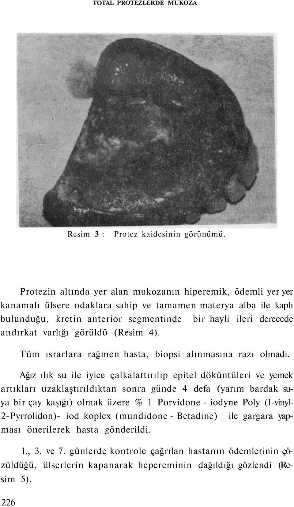 andırkat varlığı görüldü (Resim 4). Tüm ısrarlara rağmen hasta, biopsi alınmasına razı olmadı.