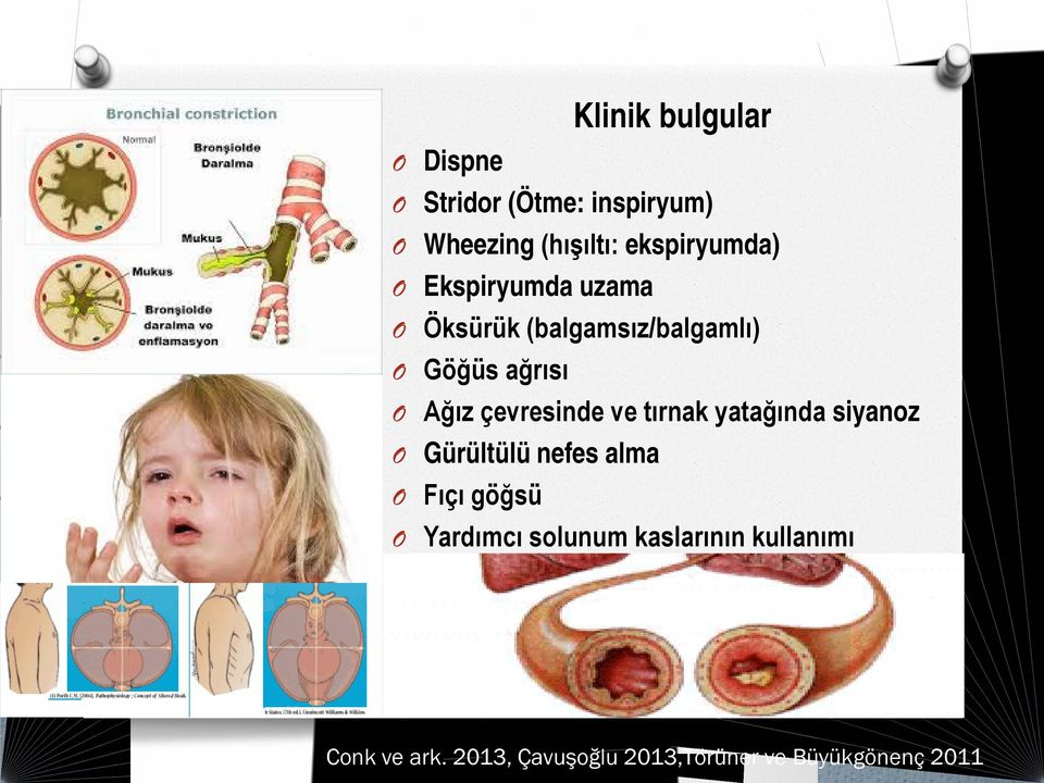 çevresinde ve tırnak yatağında siyanoz Gürültülü nefes alma Fıçı göğsü