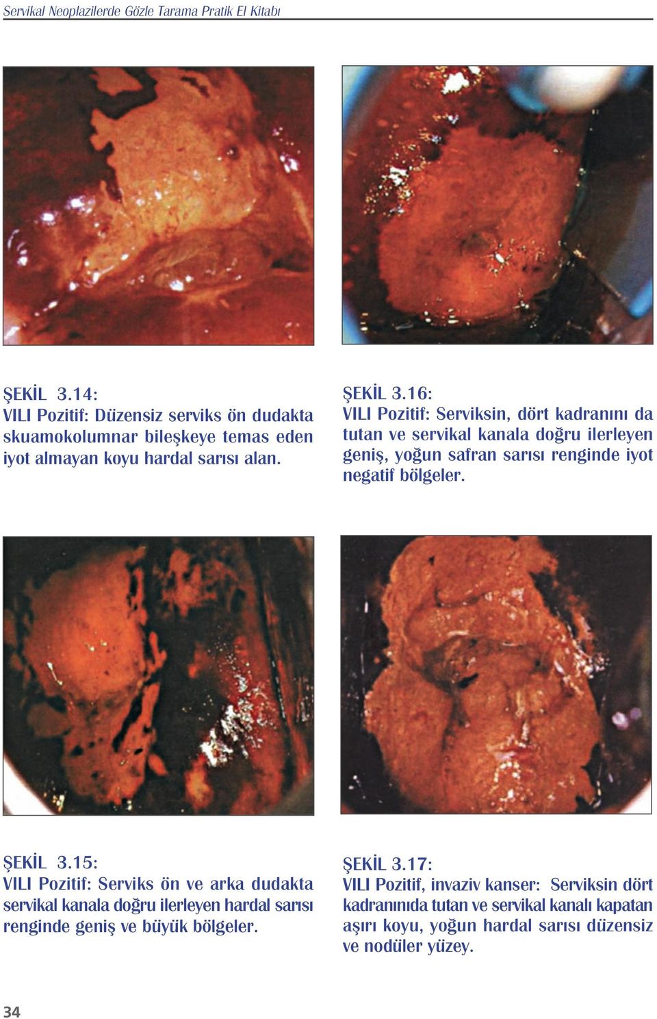 16: VILI Pozitif: Serviksin, dört kadran n da tutan ve servikal kanala do ru ilerleyen genifl, yo un safran sar s renginde iyot negatif bölgeler. fiek L 3.
