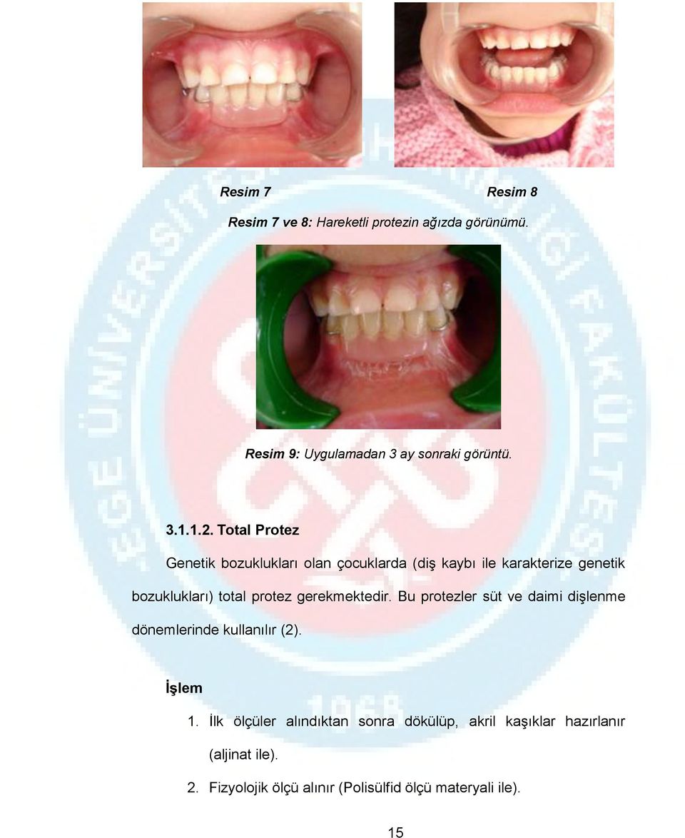 gerekmektedir. Bu protezler süt ve daimi dişlenme dönemlerinde kullanılır (2). İşlem 1.