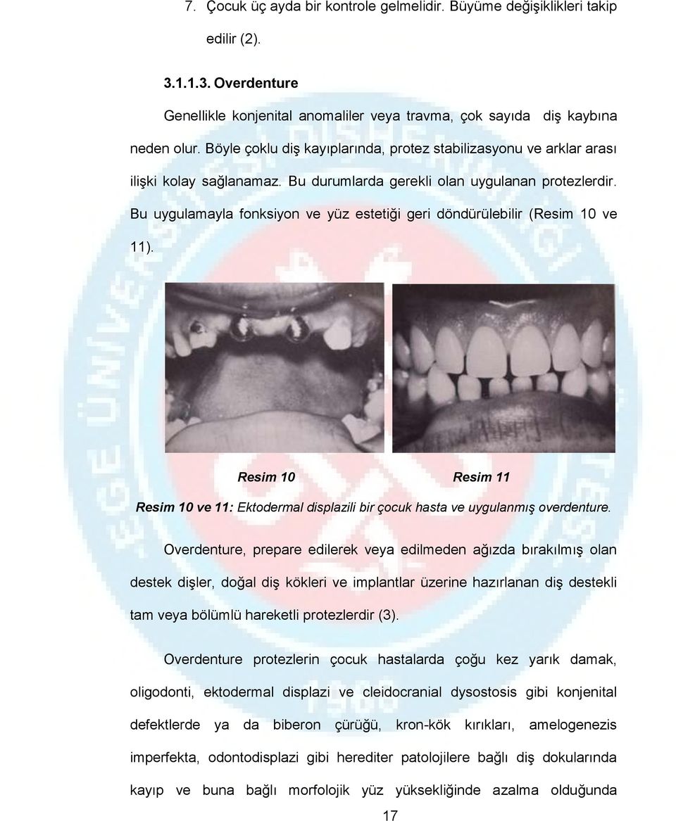 Bu uygulamayla fonksiyon ve yüz estetiği geri döndürülebilir (Resim 10 ve 11). Resim 10 Resim 11 Resim 10 ve 11: Ektodermal displazili bir çocuk hasta ve uygulanmış overdenture.